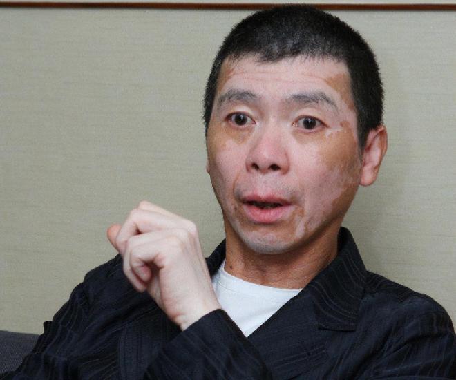 冯小刚多年的白癜风消失了