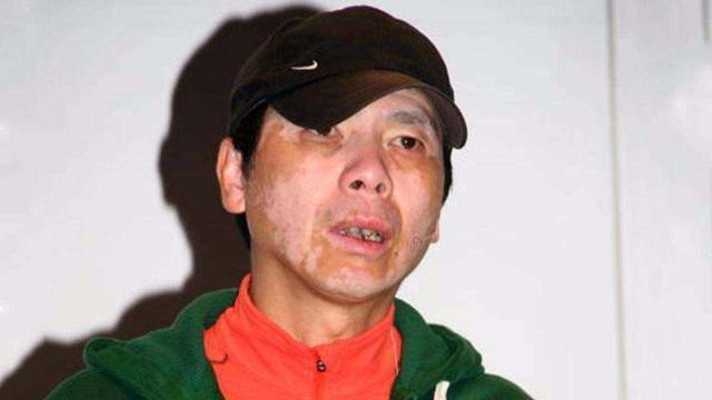 冯小刚多年白癜风病症消失！脸上光溜模样变化大，自称没吃任何药