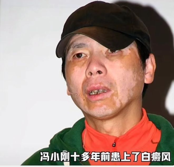 冯小刚：脸上多年的白癜风神奇的消失了，白嫩的脸庞引发全网好奇