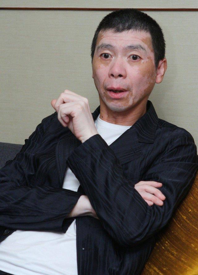 冯小刚白癜风消失了