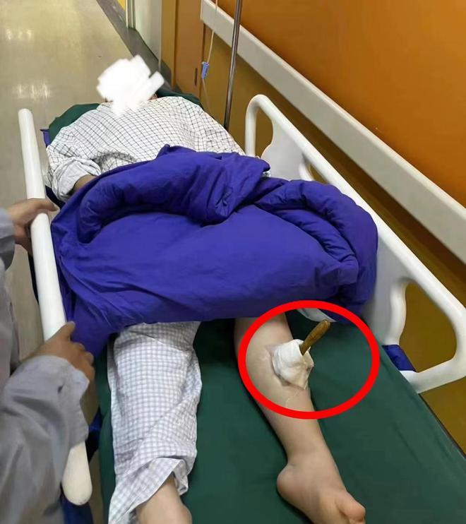 太可怕！男孩被同学用5厘米铁锥整个刺入小腿，伤人者多次霸凌