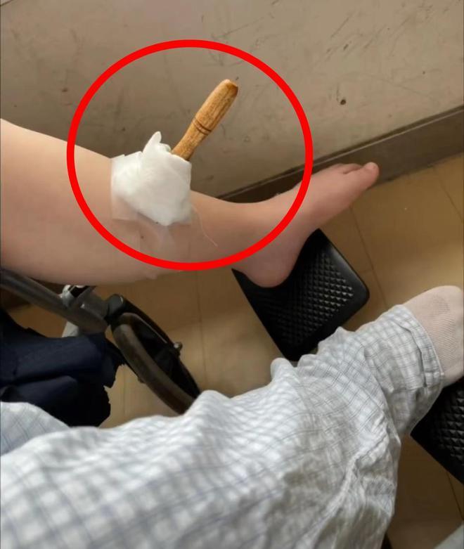 太可怕！男孩被同学用5厘米铁锥整个刺入小腿，伤人者多次霸凌