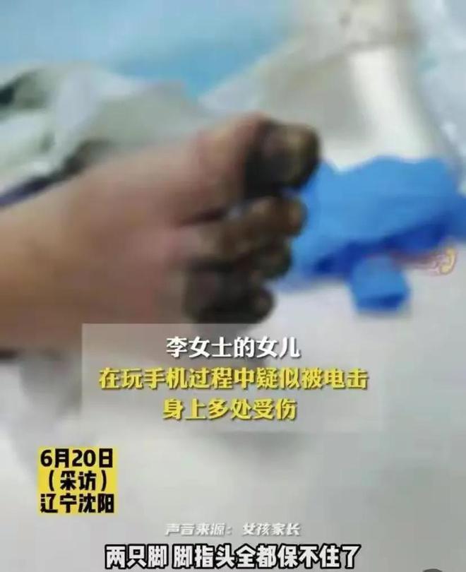 女孩充电被电击内脏受损面临截肢