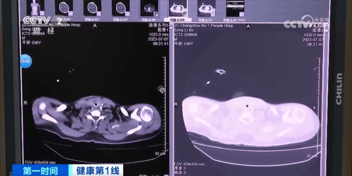 36岁男子吹空调住进ICU