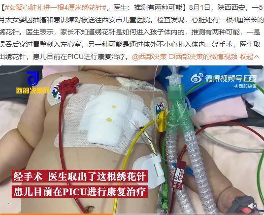 女婴心脏扎进一根4厘米绣花针