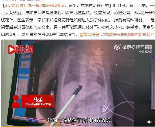 女婴心脏扎进一根4厘米绣花针