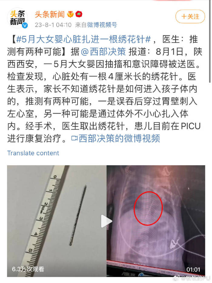 女婴心脏扎进一根4厘米绣花针