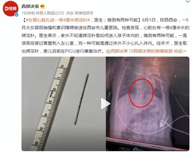 女婴心脏扎进一根4厘米绣花针，网友的评论很真实！