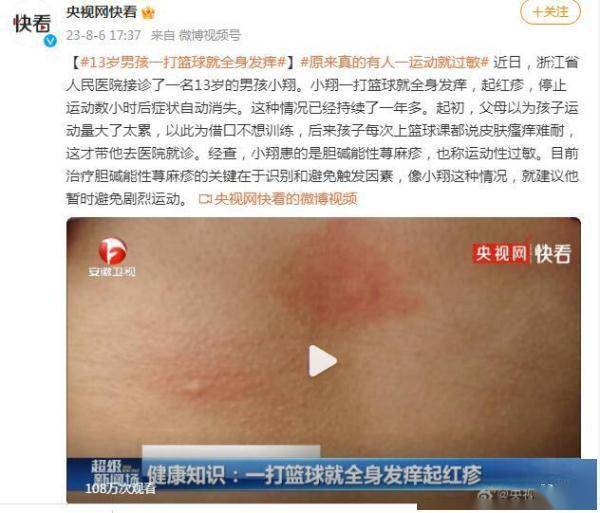 13岁男孩一打篮球就全身发痒原来真的有运动性过敏

