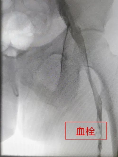 连坐12小时成大象腿