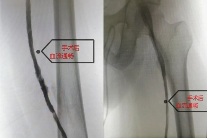 连坐12小时成大象腿