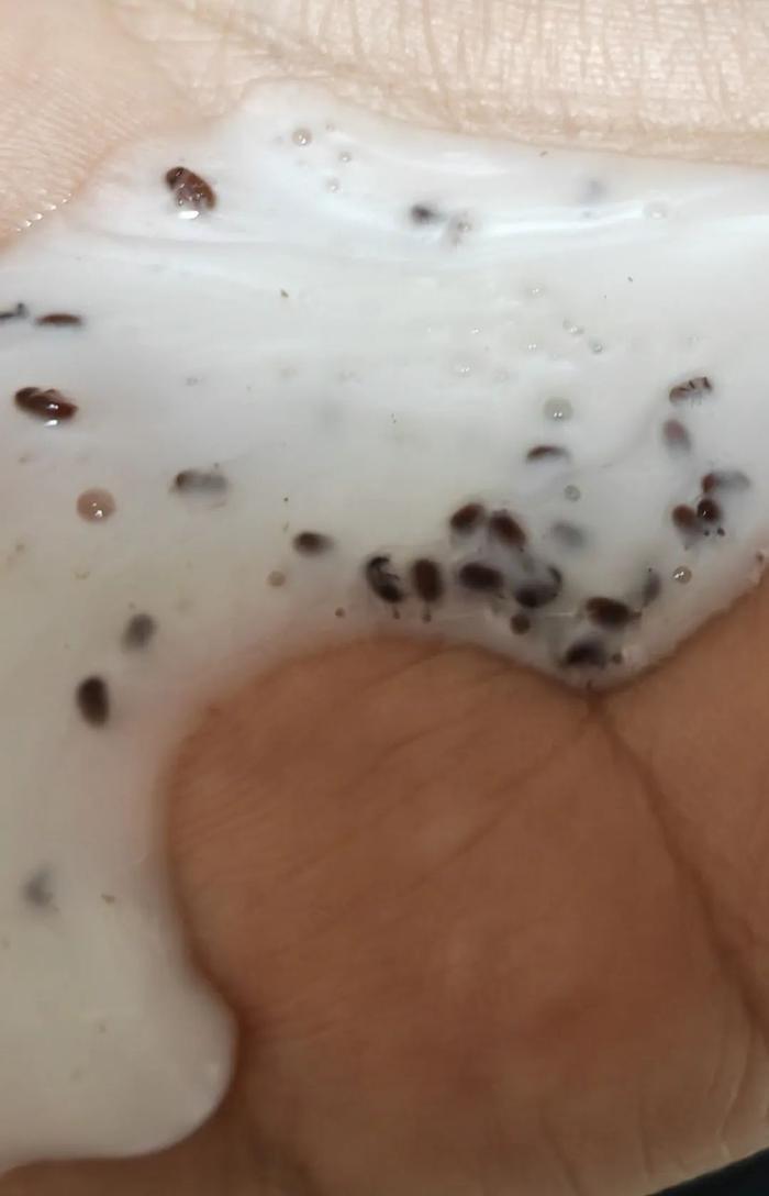 海飞丝挤出大量虫卵