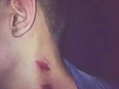 女友亲吻时用力过猛，男生紧急进医院，有个部位被亲破了……

