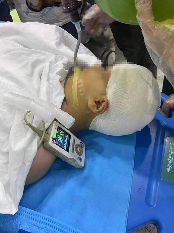 被老师打破头骨女孩仍在ICU