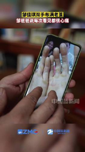 邹佳琪双手满是老茧
