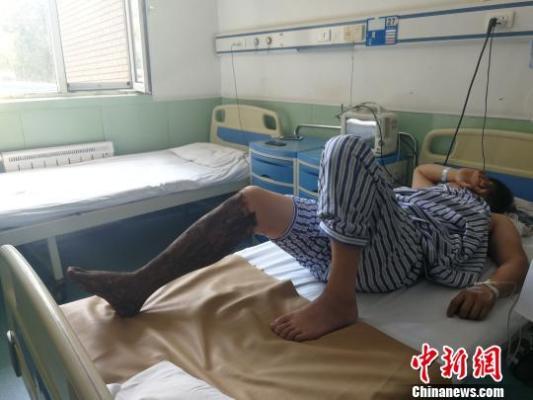 男子小区内被毒蛇咬伤全身多处发麻及时送医救治