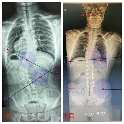 女孩罕见病致脊柱侧弯62°，上海医生巧手矫正