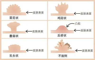 性病防护：避孕套并非万能，如何有效预防？